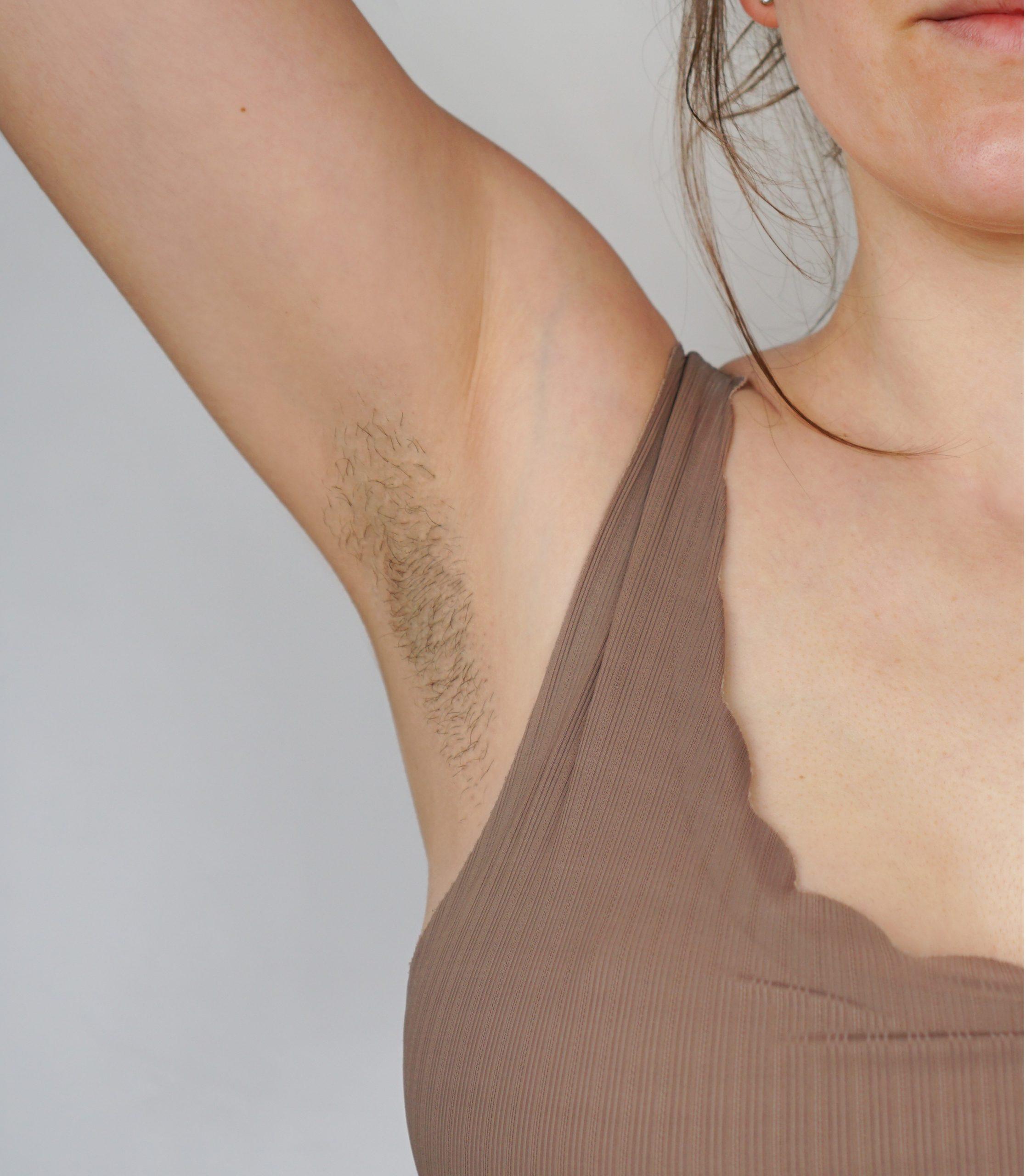 Armpit before laser hair removal treatment