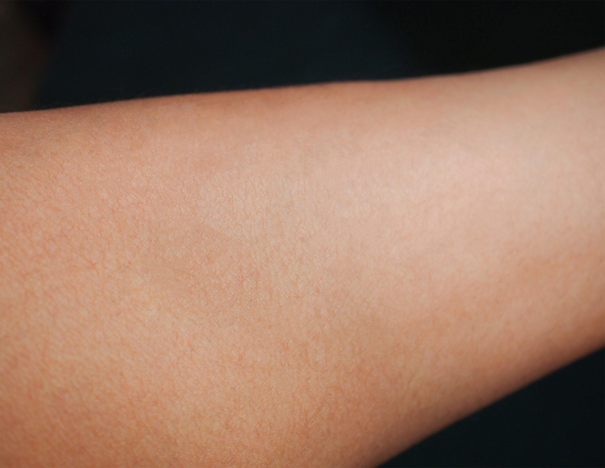 Smooth arm after laser hair removal treatment