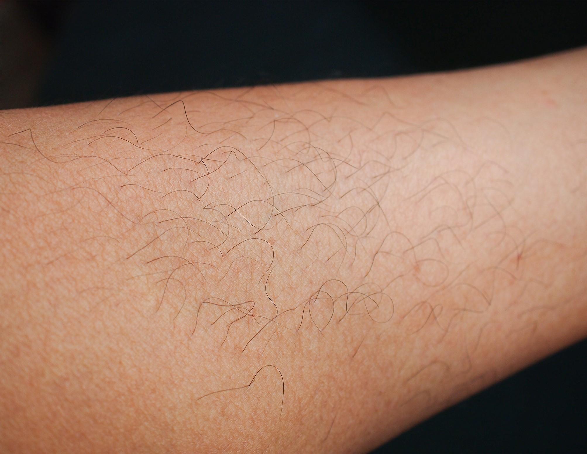 Hairy arm before laser hair removal