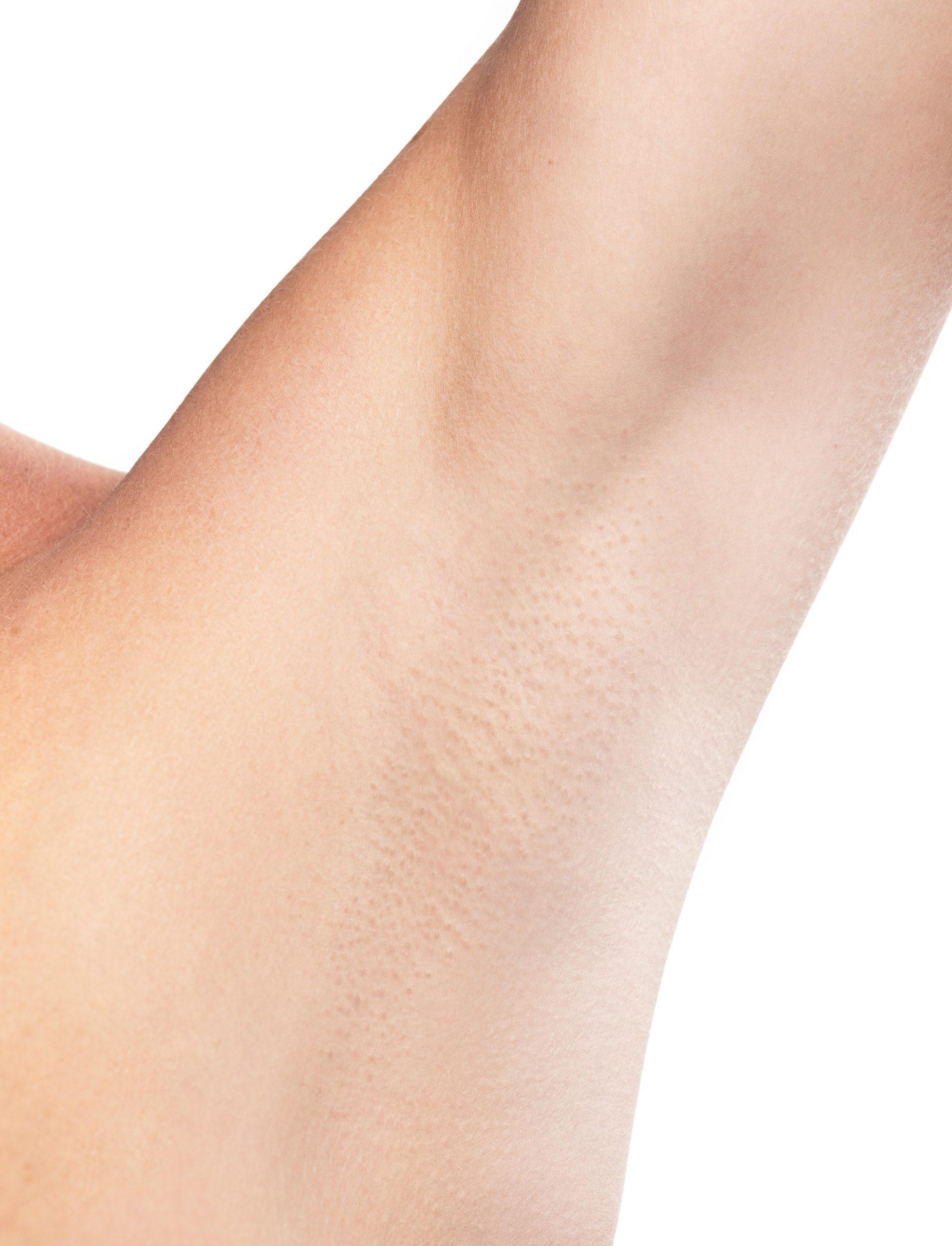 Laser hair removal results on underarm