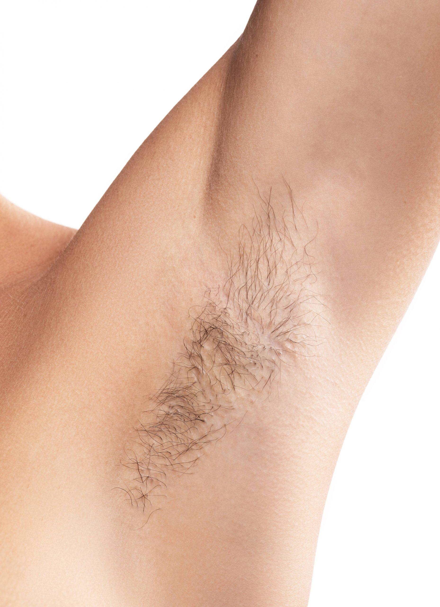 Underarm before laser hair removal treatment