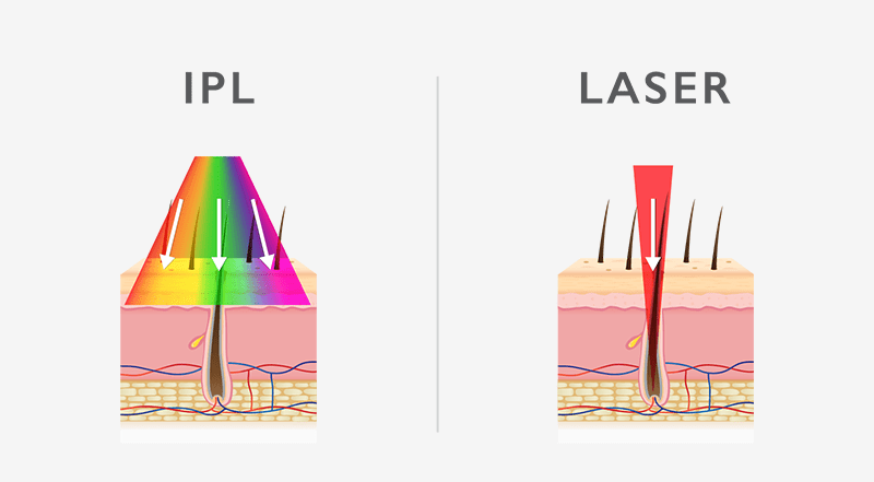 Laser vs IPL Hair Removal
