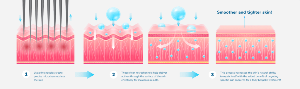 Imedpen microneedling process